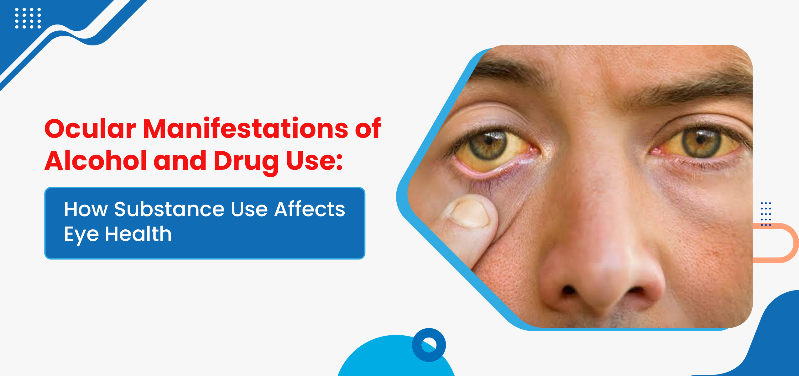 Ocular Manifestations of Alcohol and Drug Use: How Substance Use Affects Eye Health