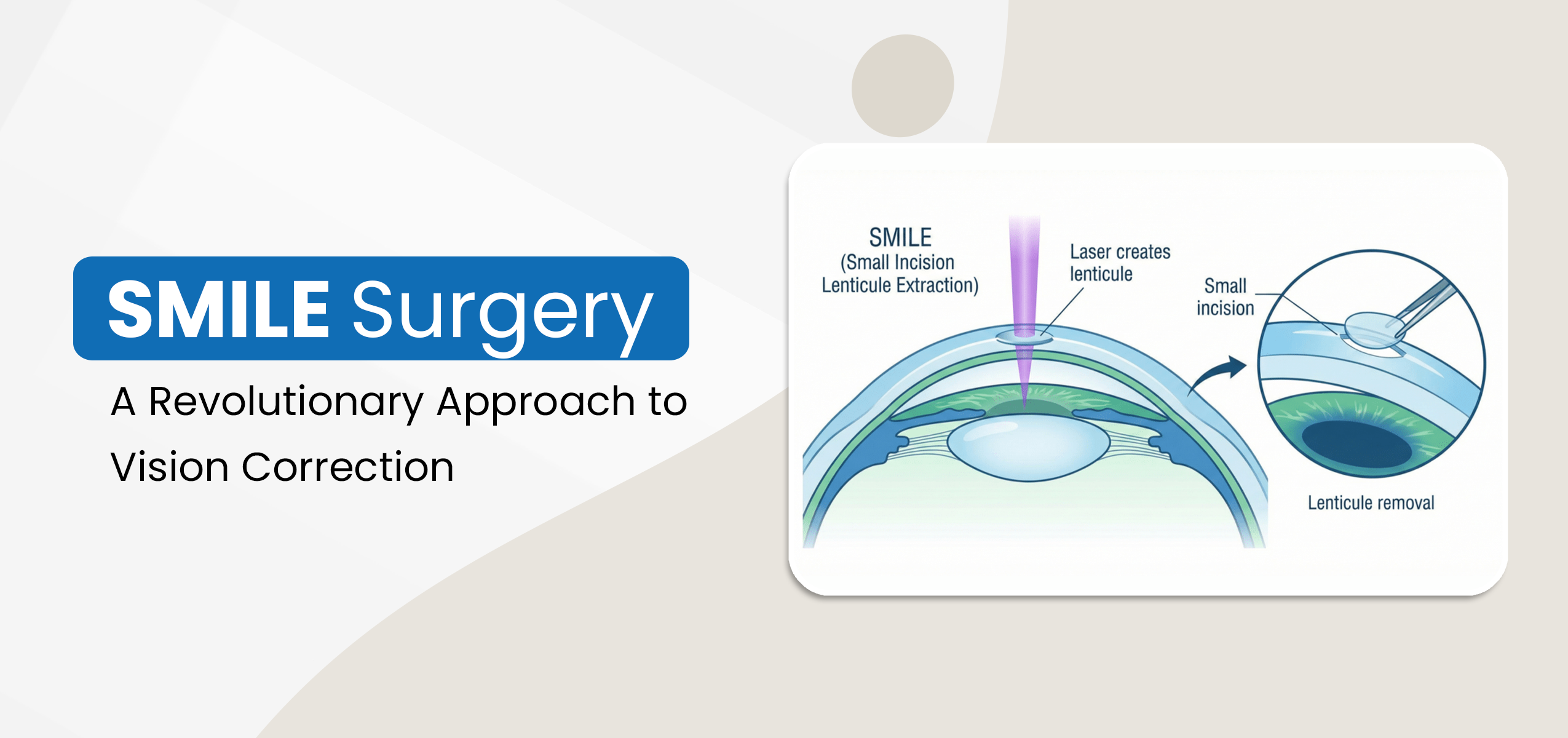 SMILE Surgery: A Revolutionary Approach to Vision Correction