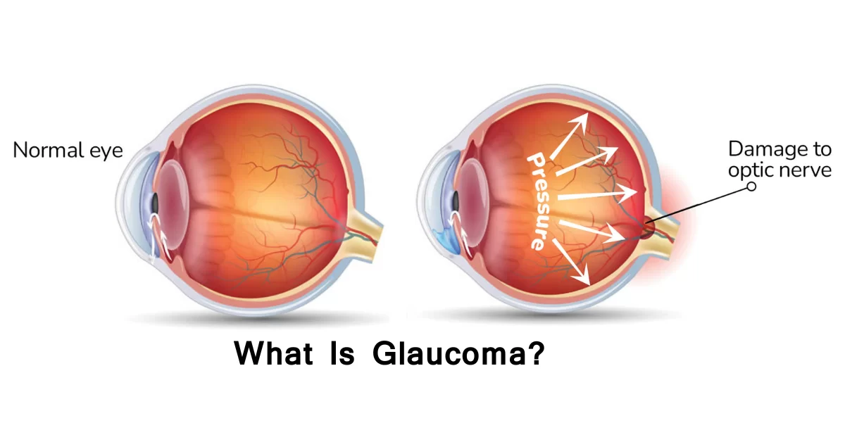 Understanding Glaucoma: A Comprehensive Guide