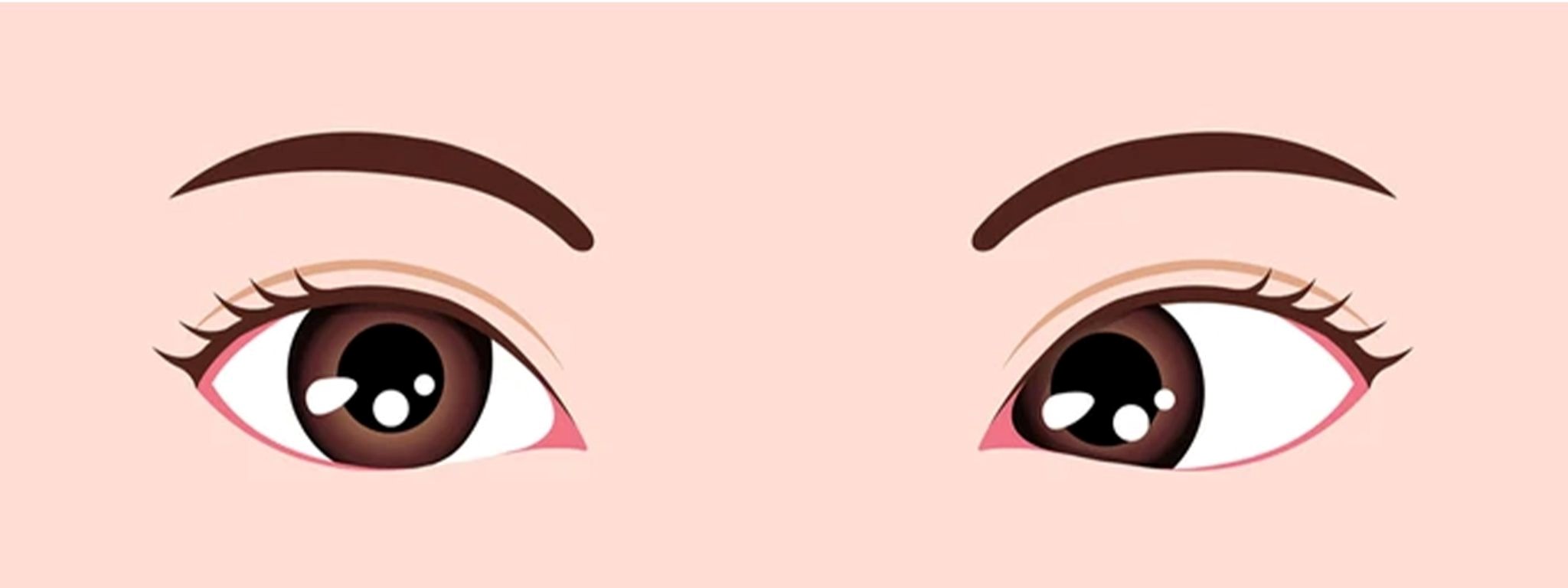 Strabismus: Types, Causes, Symptoms, Diagnosis and Managment